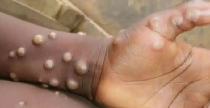 Madagaskar’da ilk defa M çiçeği vakası tespit edildi