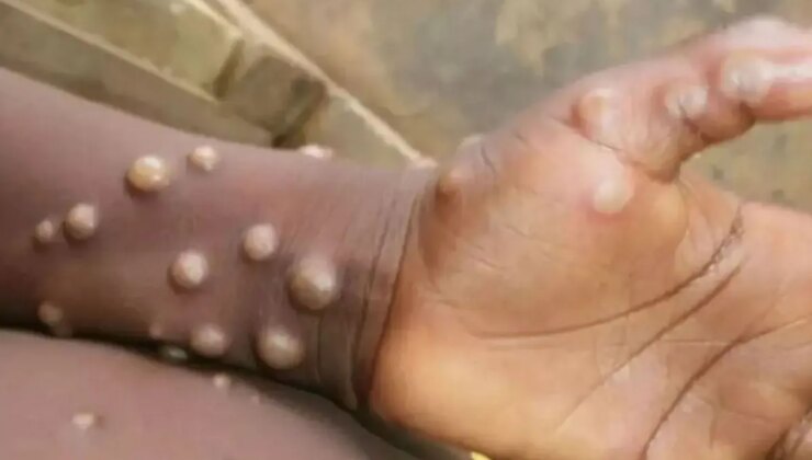 Madagaskar’da ilk defa M çiçeği vakası tespit edildi